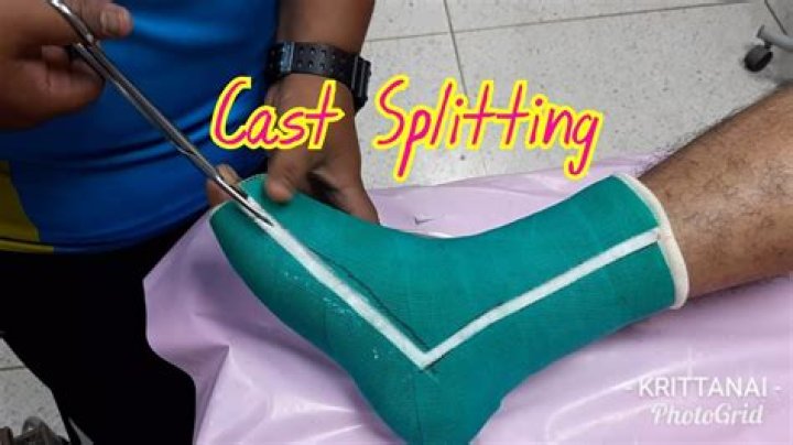 5 Crazy Facts About Cast Splitting