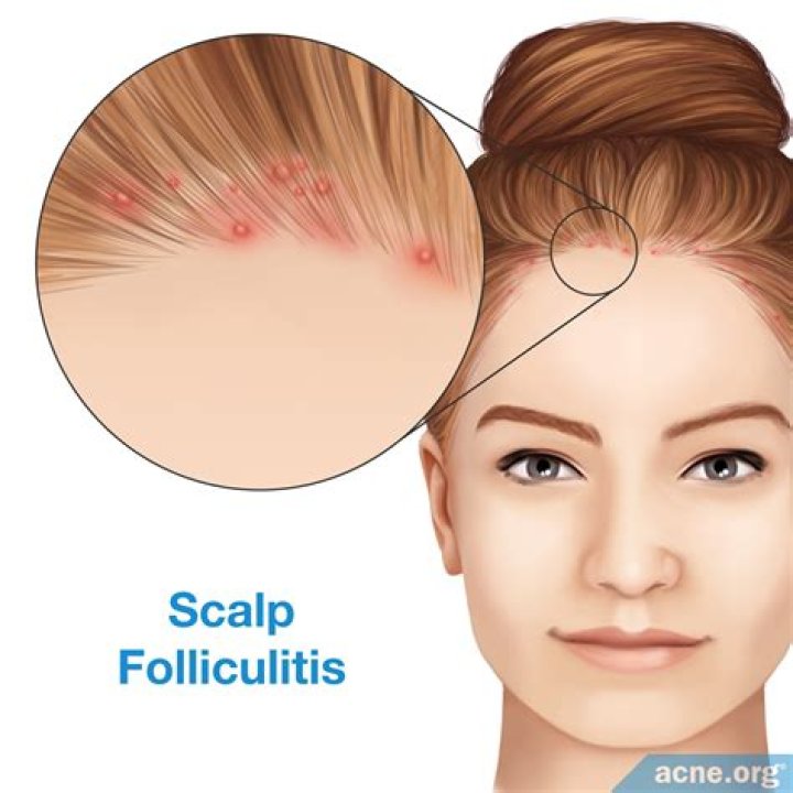 Scalp Acne: Common Causes & And How To Treat It Effectively