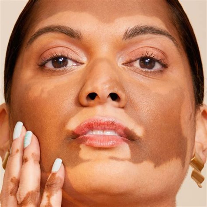 Toasted Skin Syndrome: What Is The Heat Rash, What Causes It & How Do I Treat It?